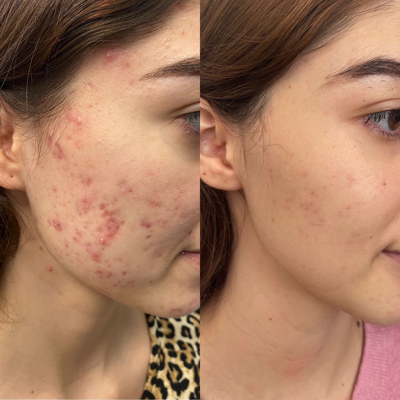 Post-acne marks