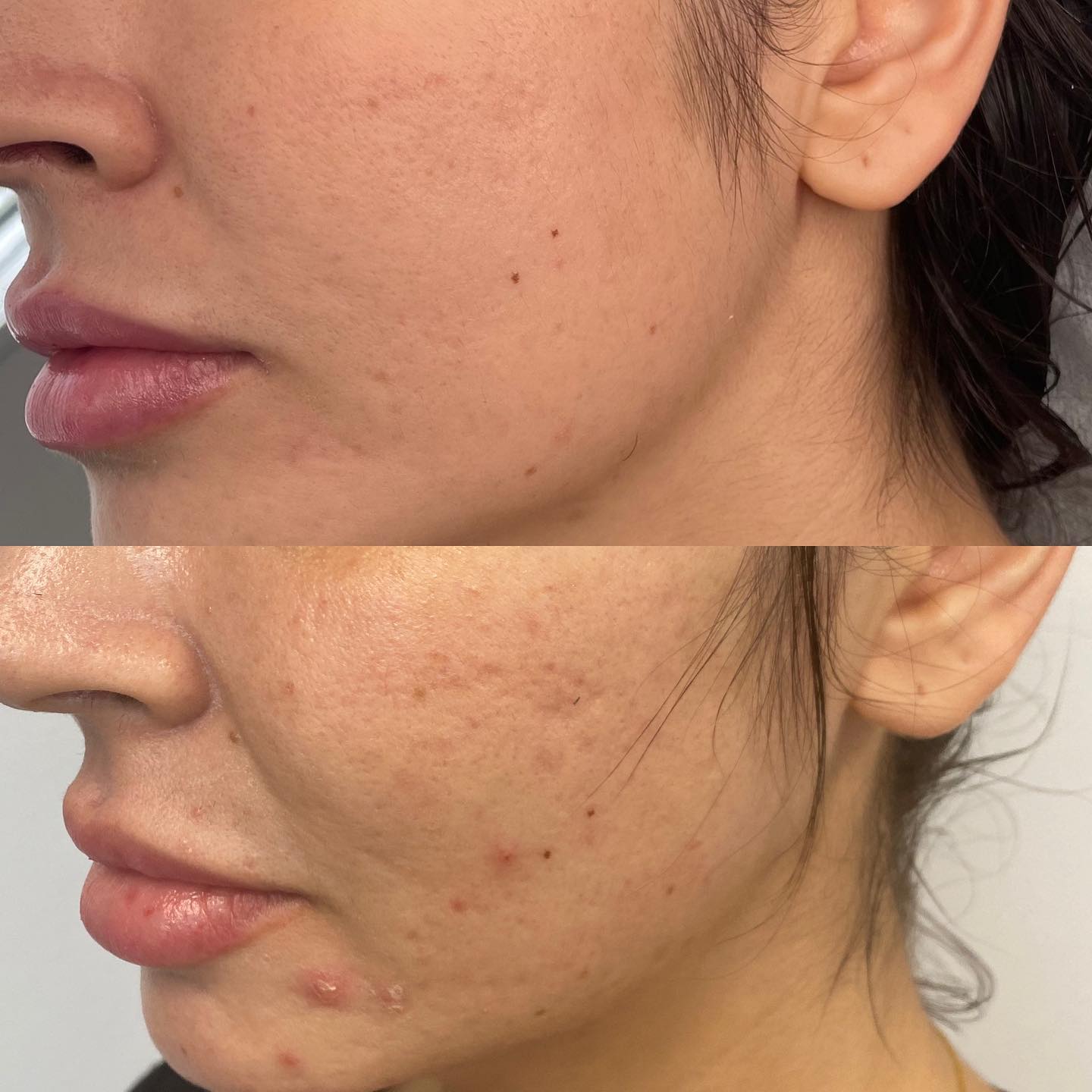 Bottom picture (before)/top pic (after) Restore your skin’s youthful radiance and slow the effects of aging with micro needli