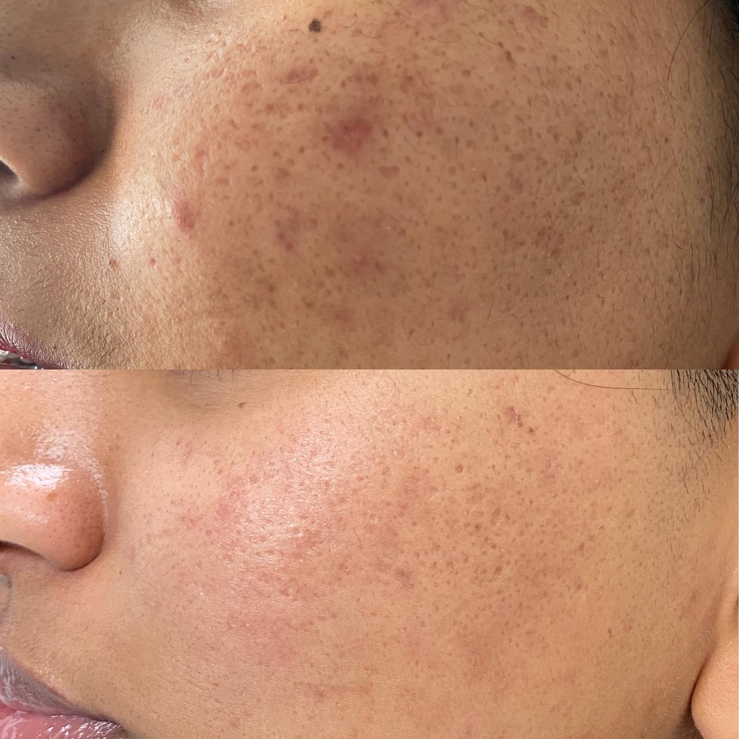 What we started with, what we have now! ✨ Morpheus8 is a minimally invasive skin rejuvenation treatment, utilizing a matrix o