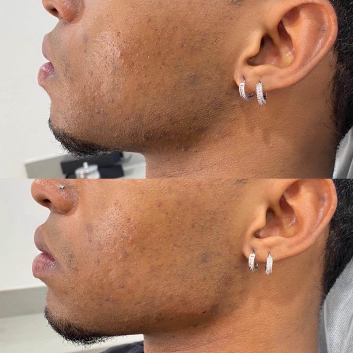 This is a noninvasive procedure that uses dermal fillers to shape, define, and enhance the lower facial contours. Benefits: ✨