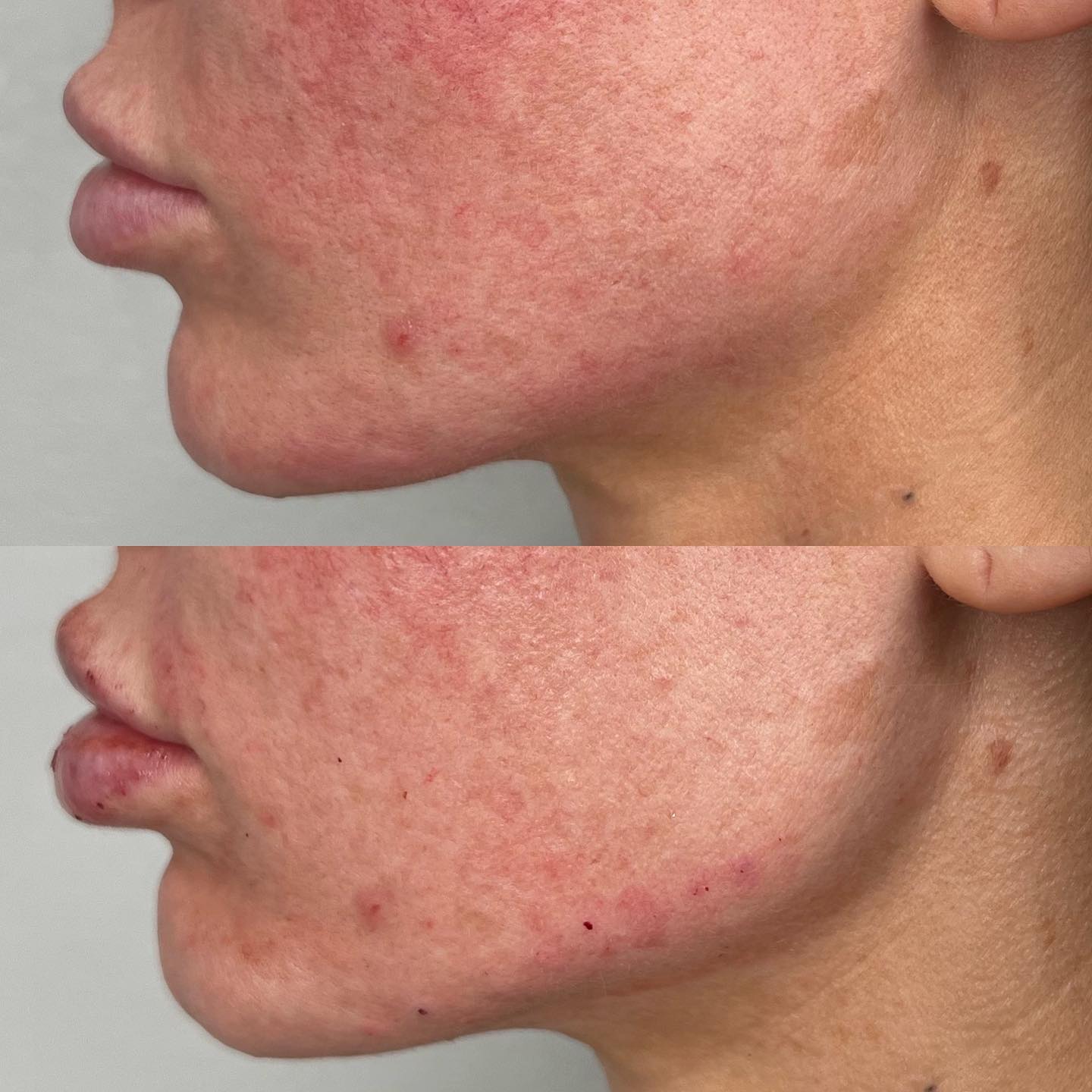 Snatched jawline by @nurse.gohar We added volume to define and lift the skin and tissue around the jawline and neck to give p
