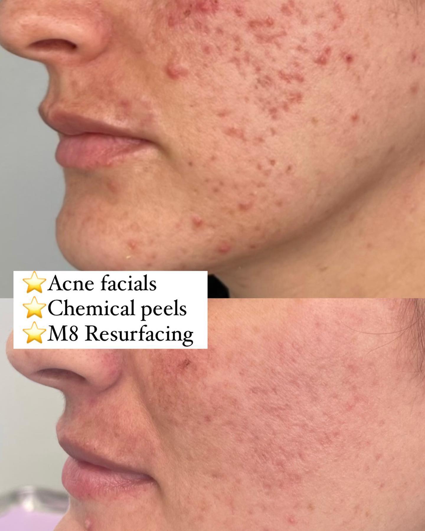 WHATS AN ACNE? 📛An acne lesion (pimple) grows when bacteria, oils and dead skin fill up and inflame pores, the tiny openings