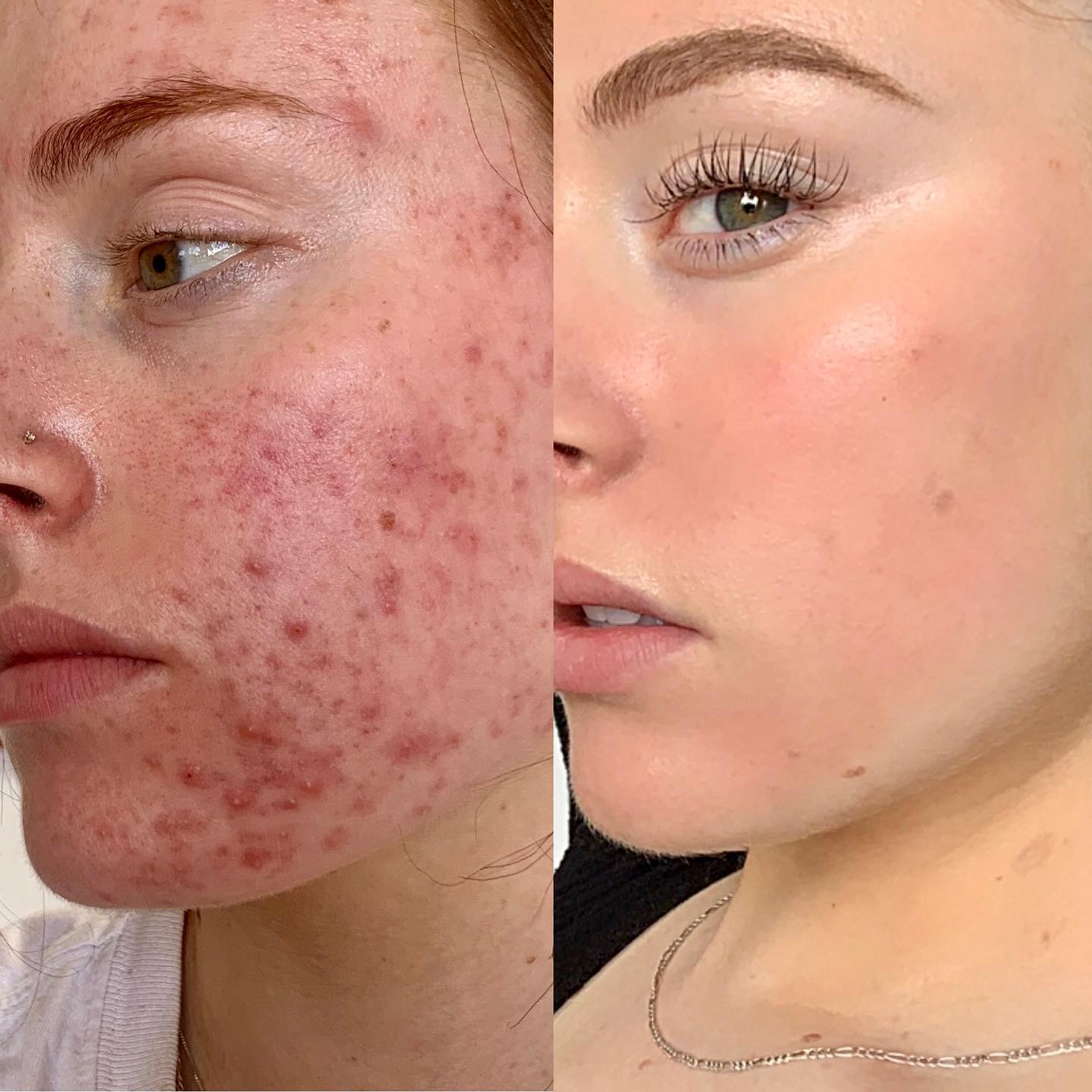 Acne can cause emotional distress and scar the skin. Good news is that acne is treatable and with consistency, you can comple