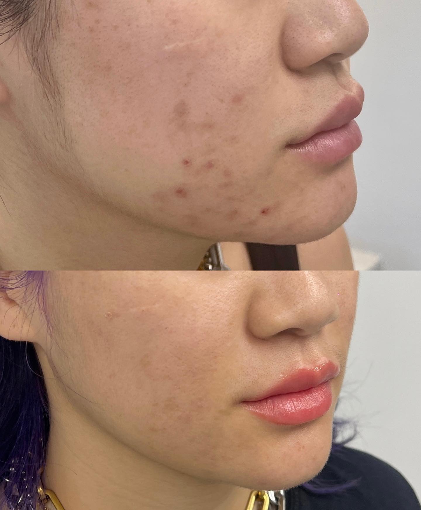 Texture goals! Our beautiful client had some textural issues, with 3 months of consistency and combination of a few treatment