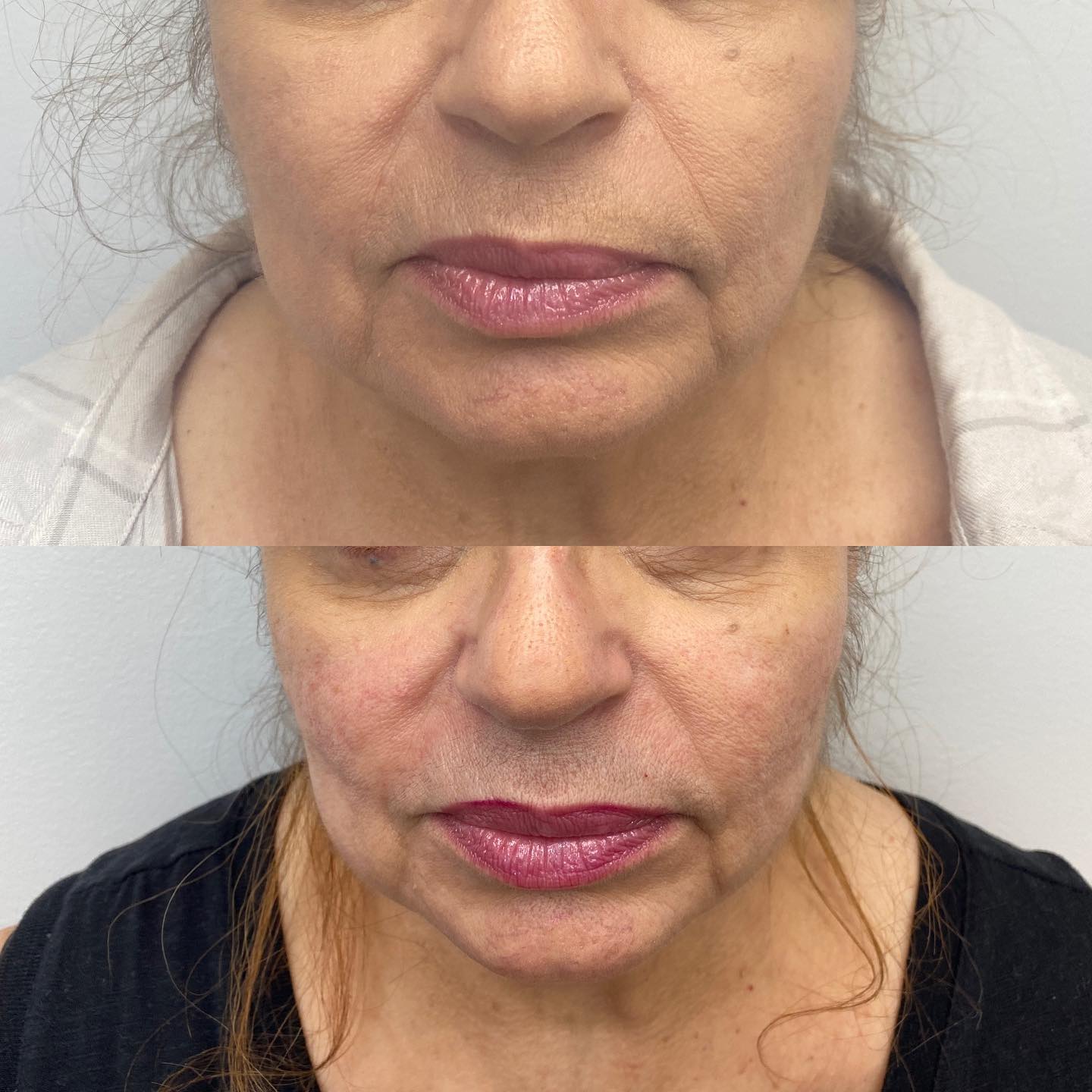 After 1 session. Want to increase your collagen production to fight aging? Morpheus combines microneedling and high radio fre