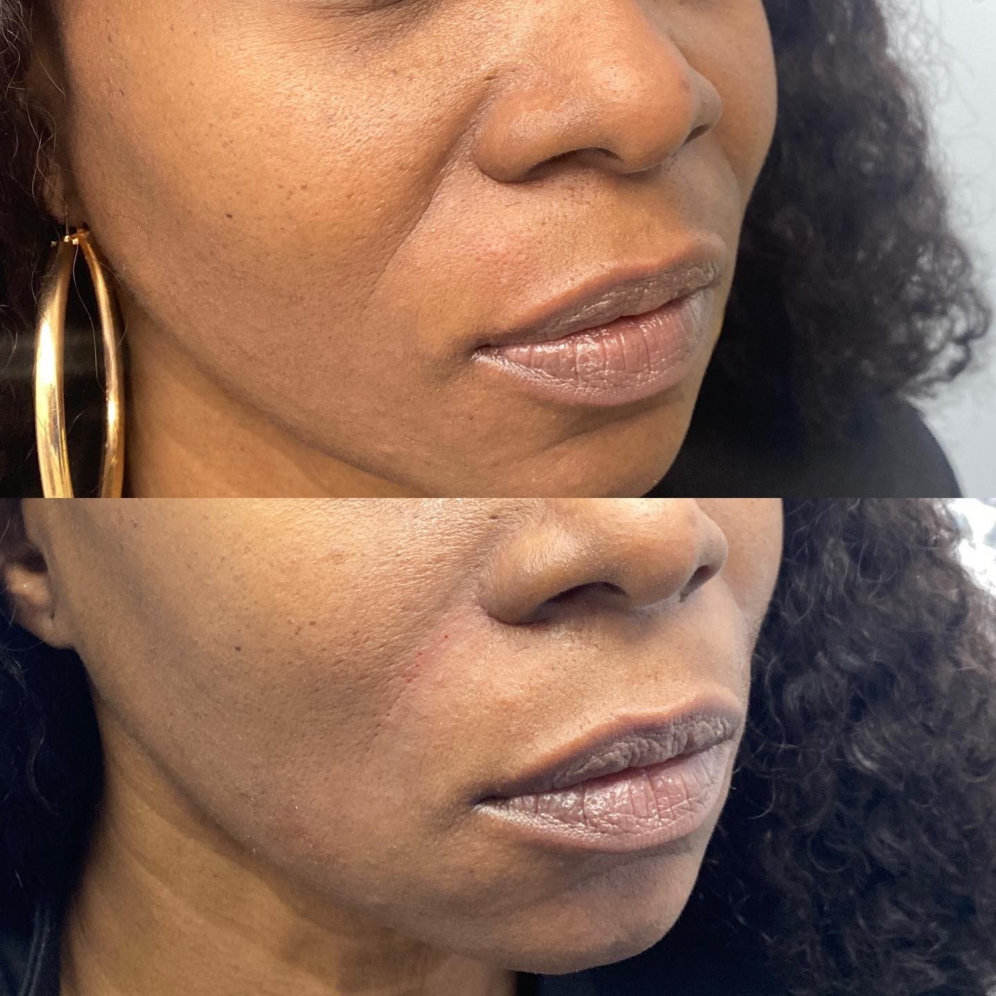 Smile line correction For smile lines, we apply hyaluronic acid filler via injection along the crease extending from the nose