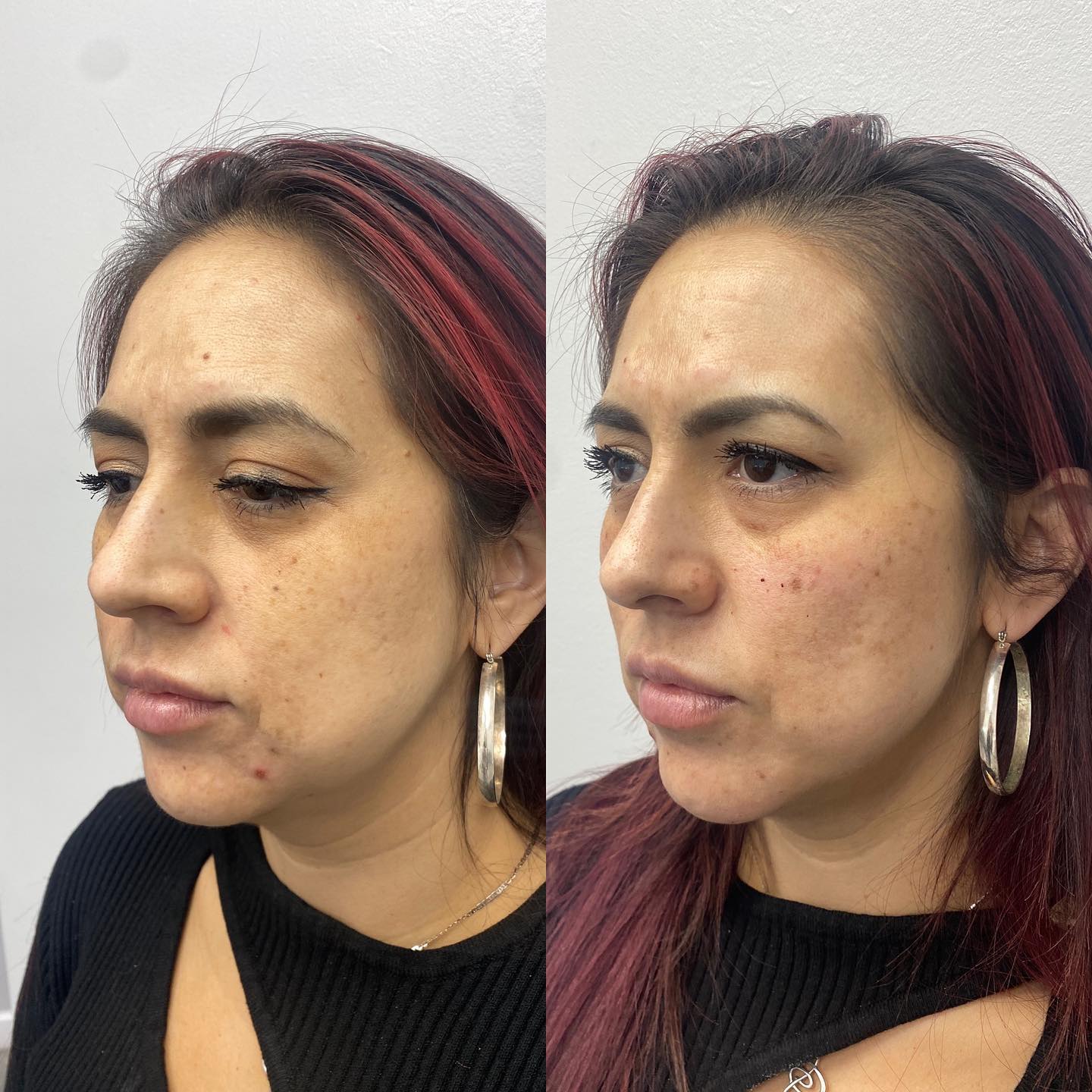 Did you know that getting cheek fillers can help raise low or barely visible cheekbones? It provides the illusion of a more d