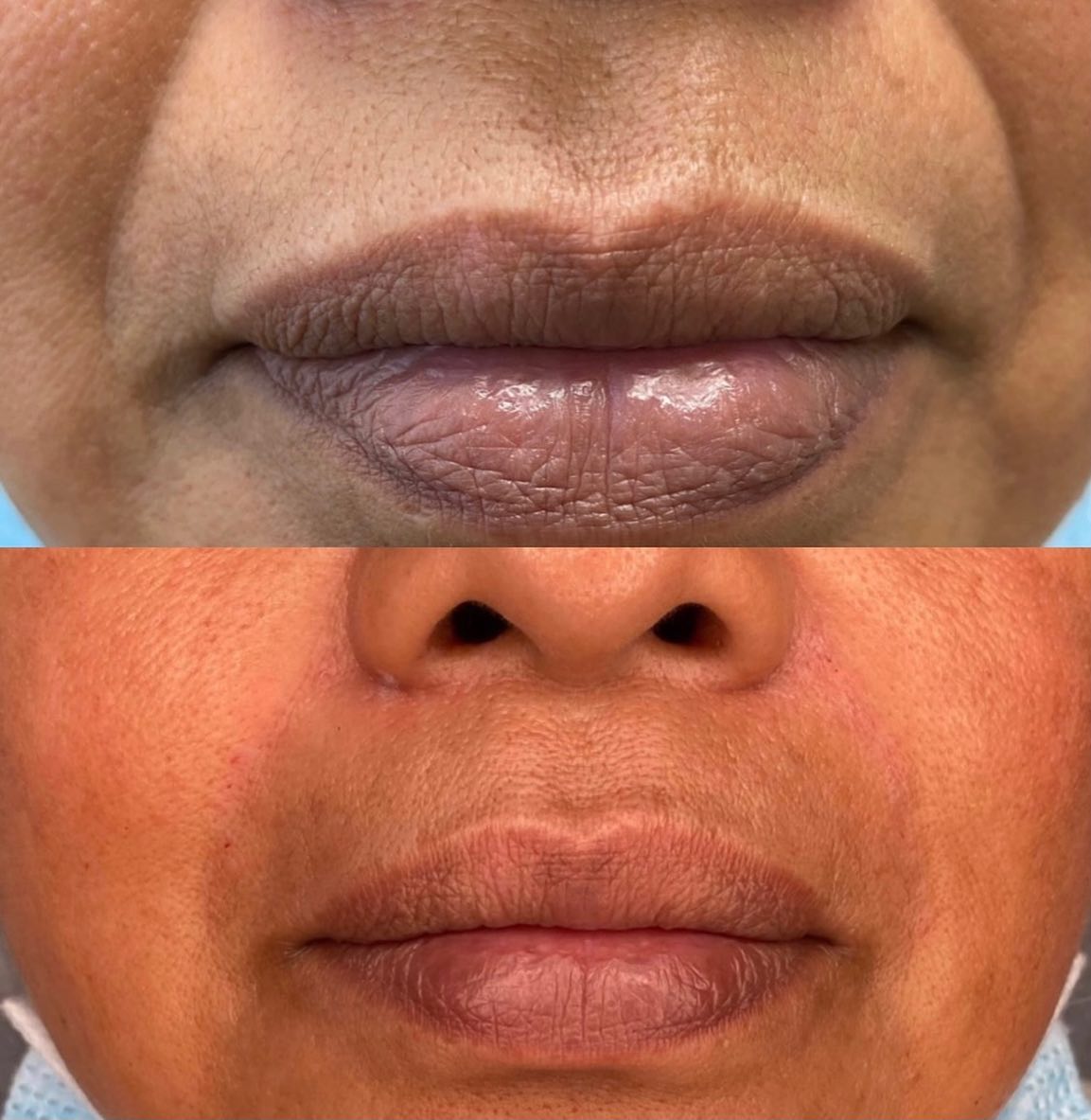 💉Smiling is definitely one of the best beauty remedies. But smiling a lot will create unwanted lines. Thankfully, dermal…