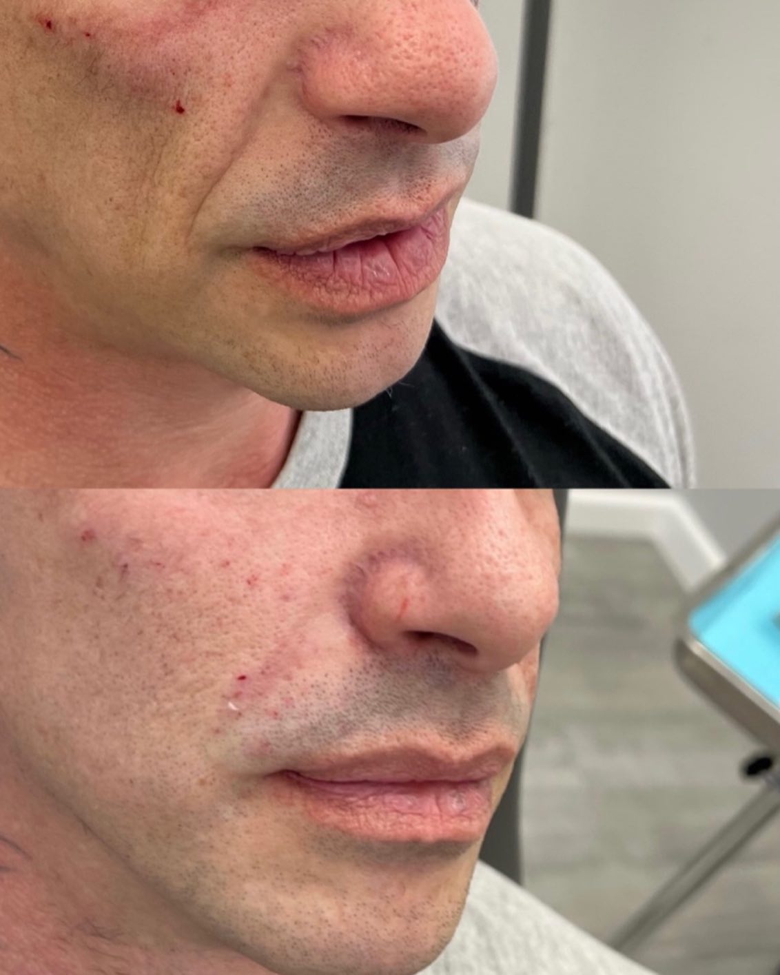 💉We used dermal fillers to help reduce the appearance of flat cheeks and smile lines. 😷One advantage of these fillers is…
