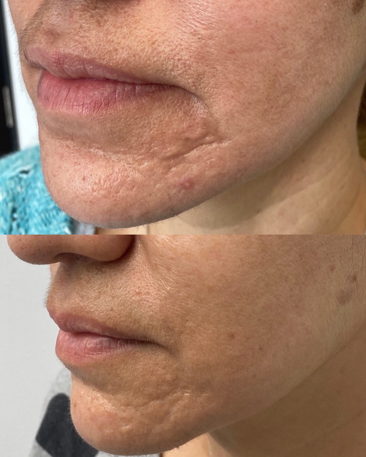 We addressed the clients main concerns, her scars and pigmentation, with 3 sessions of microneedling also known as collagen i