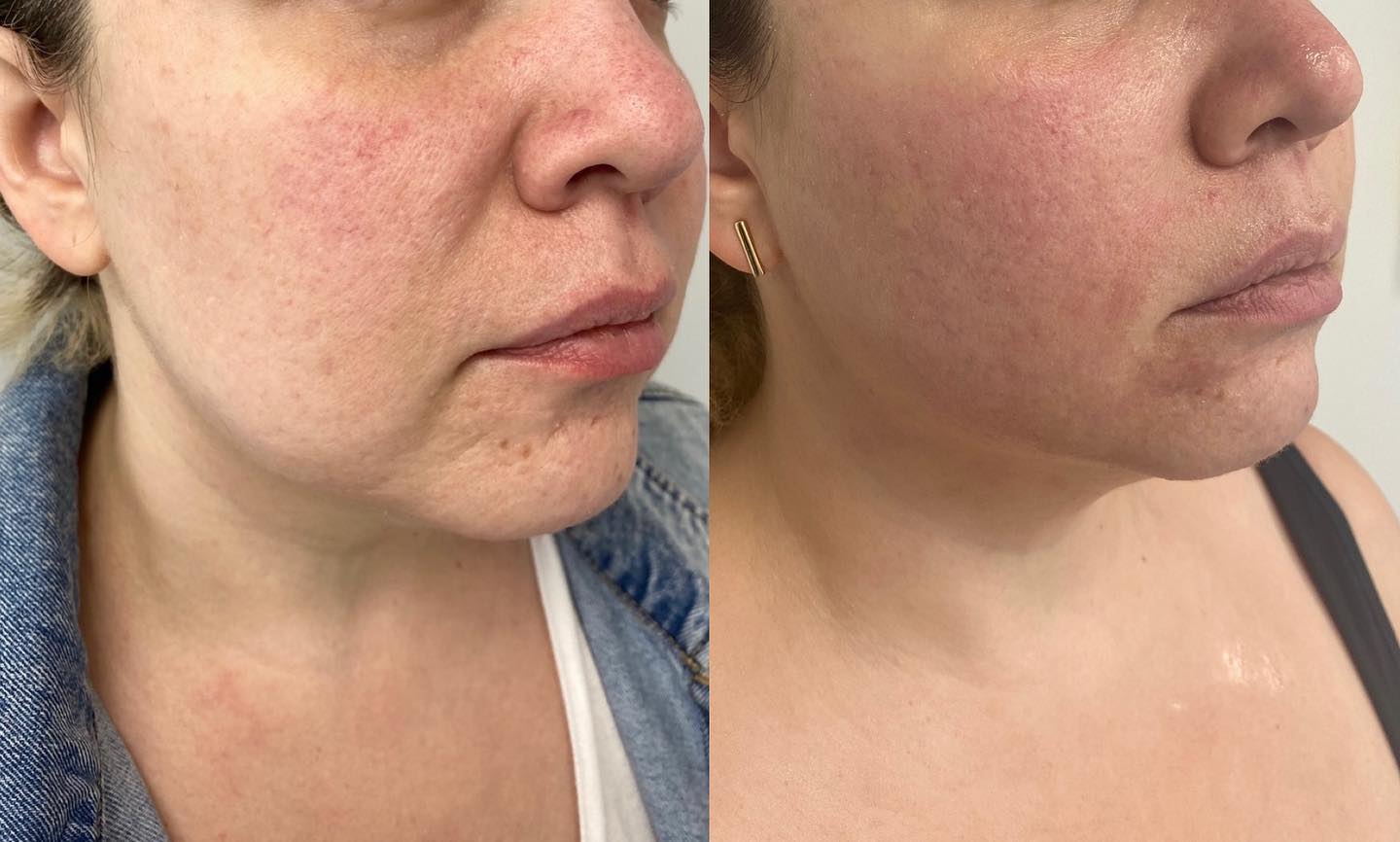 MORPHEUS8 -INCREASES COLLAGEN PRODUCTION AND ELASTICITY - REMODELS, THICKENS AND TIGHTENS SKIN -IMPROVES TEXTURE AND COMPLEXI