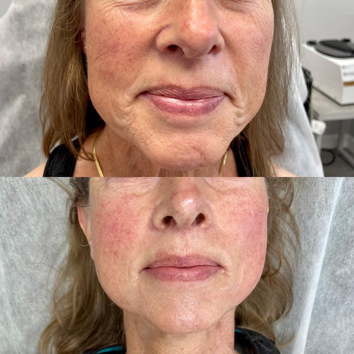 Photos are taken 30 minutes apart. WHAT DOES IT DO? ⭐️One of the best non surgical treatments to ✨tighten and contour the ski