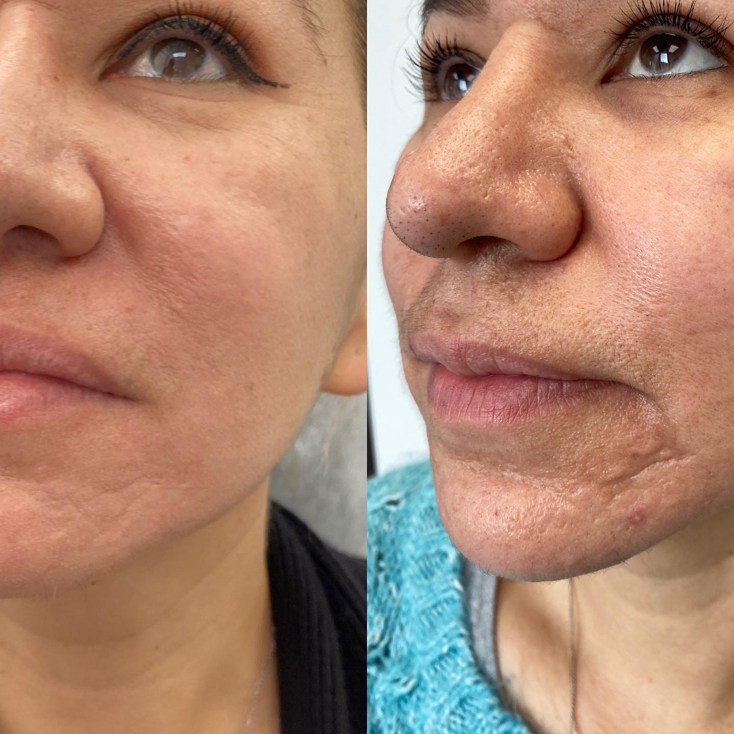 TEXTURE GOALS! ✅ Our beautiful client has done a combination of microneedling + Morpheus8 for these results. No more scars! ❌