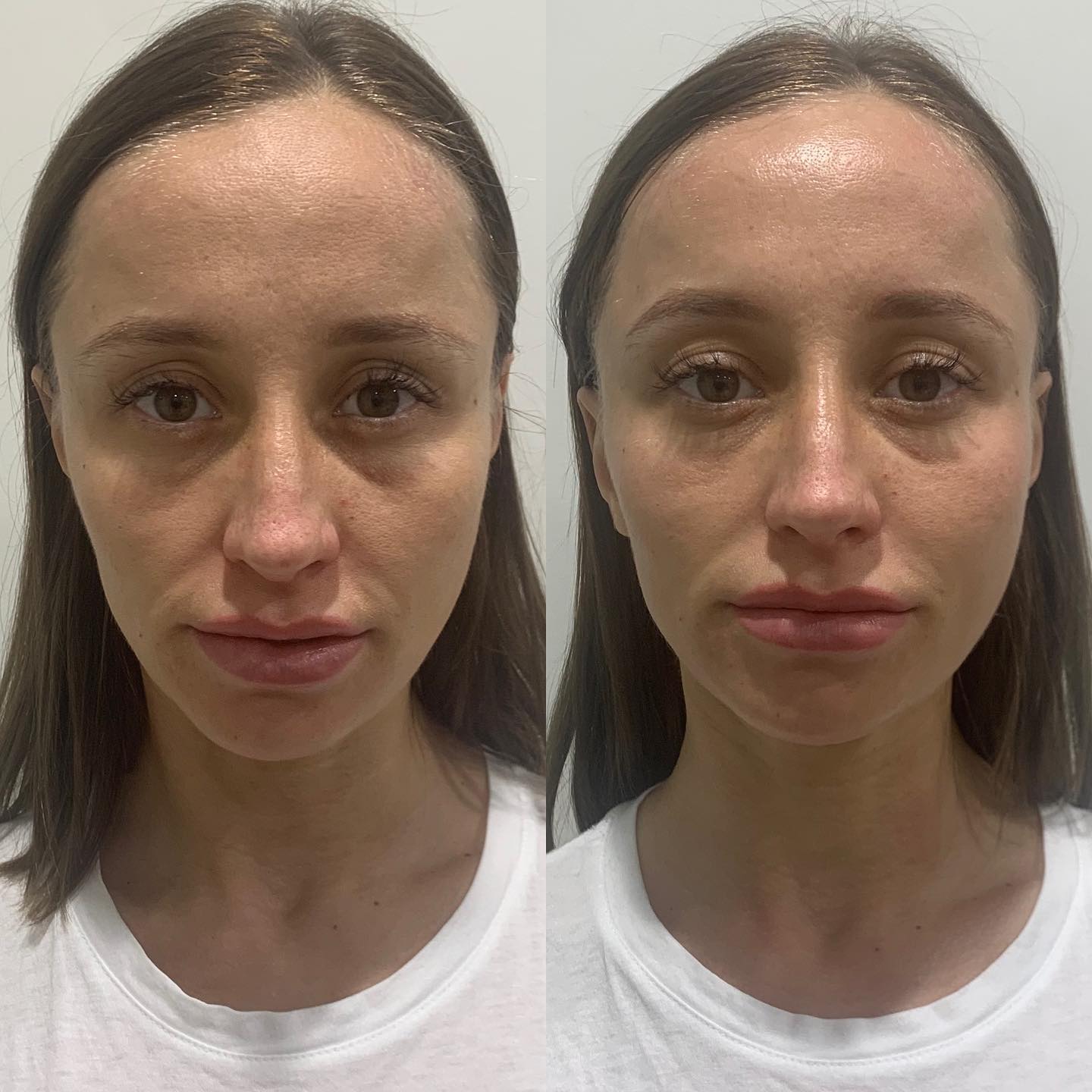 FORMA is a revolutionary innovation in treating wrinkles and sagging skin without the surgery, pain or downtime. FORMA is one