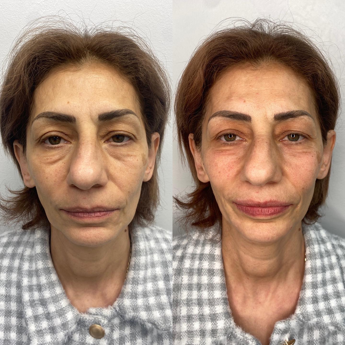 Full facial contouring with dermal fillers! This was the first time our client got anything done. We used 3 syringes of @rest
