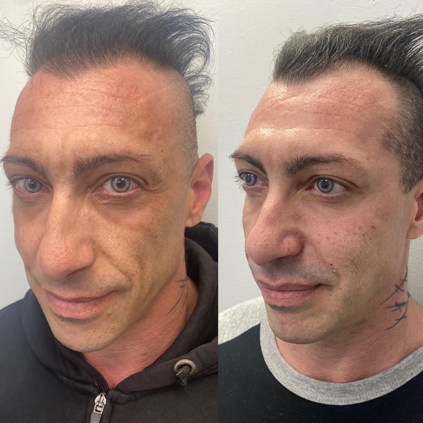Morpheus8 + Cheek Fillers Our client wanted skin tightening + some fillers to fill the hollowness around his cheeks. He looks