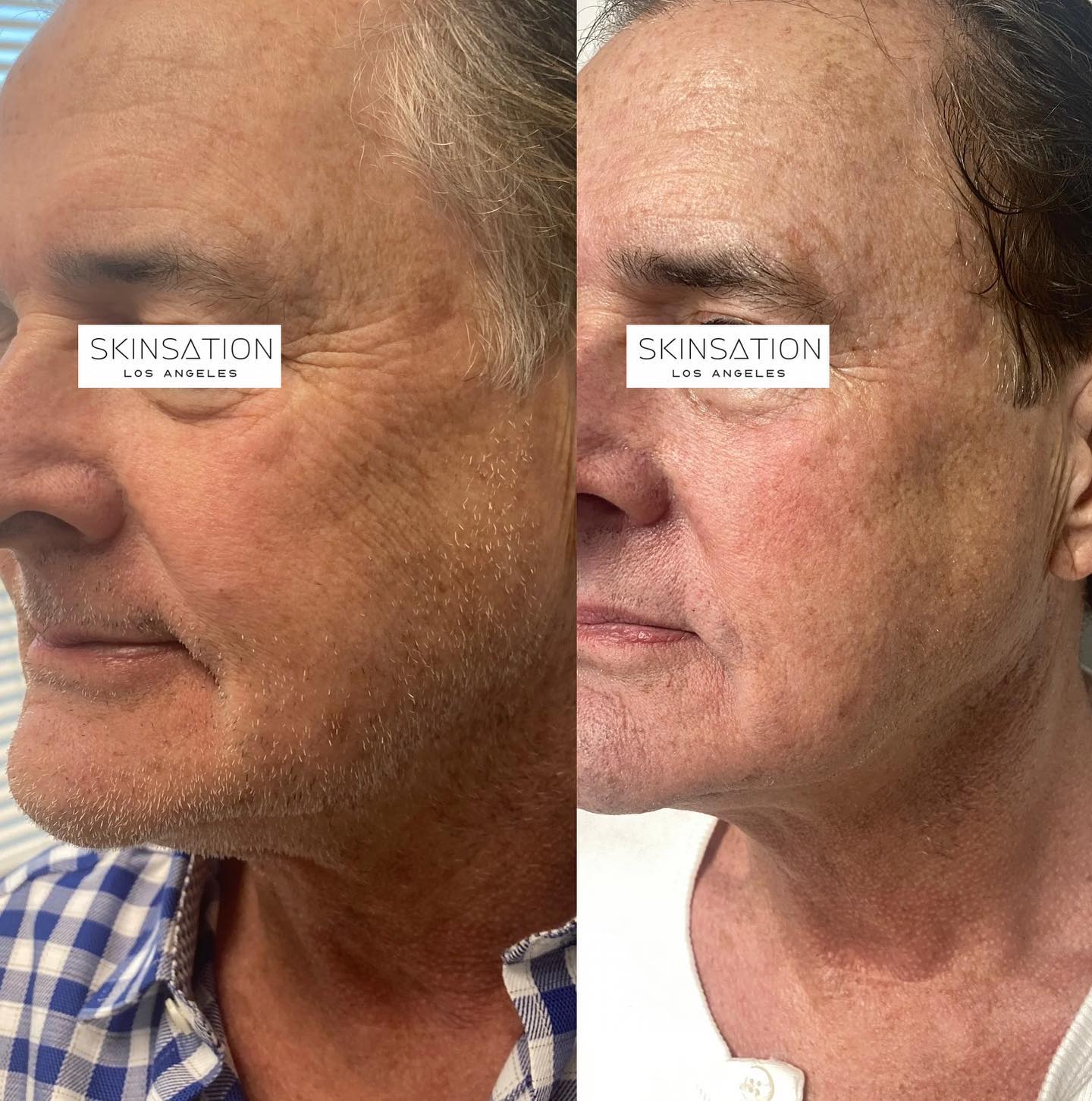 Maybe he was born with it, or maybe it’s #Morpheus8 Neck Tightness ✅ Reduced appearance of smile lines and jowls✅ Less fine l