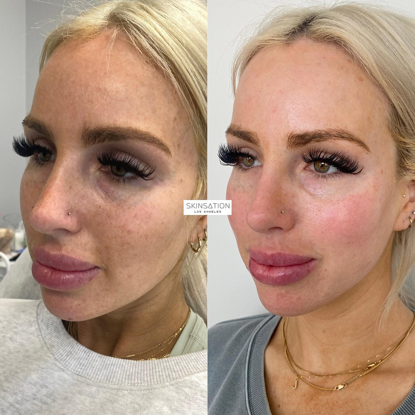 FORMA + IPL 🎯Our pretty girl wanted a quick forma for contouring + IPL laser to reduce the pigmentation ⚡️Forma: Using radio