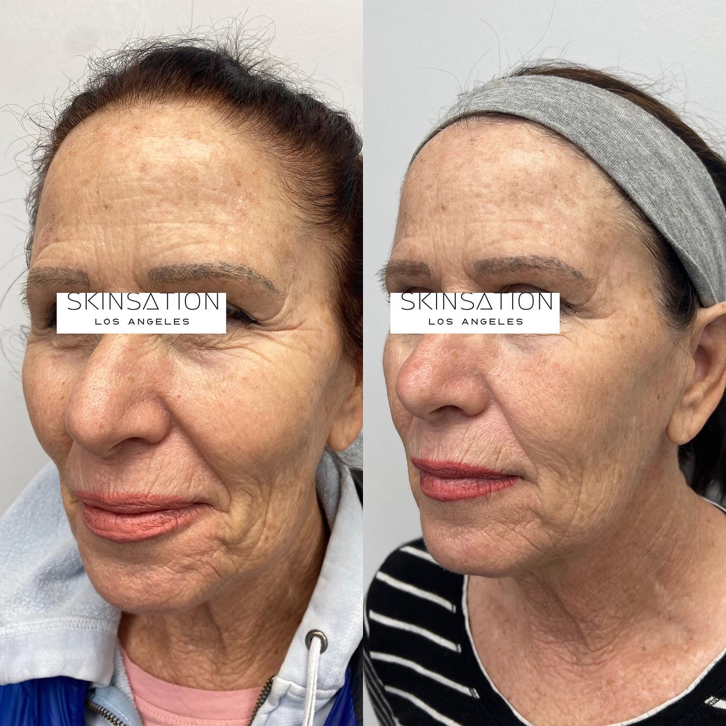 Talk about skin tightening!!! The client has less fine lines and wrinkles, less visible smile lines and jowls, her skin looks