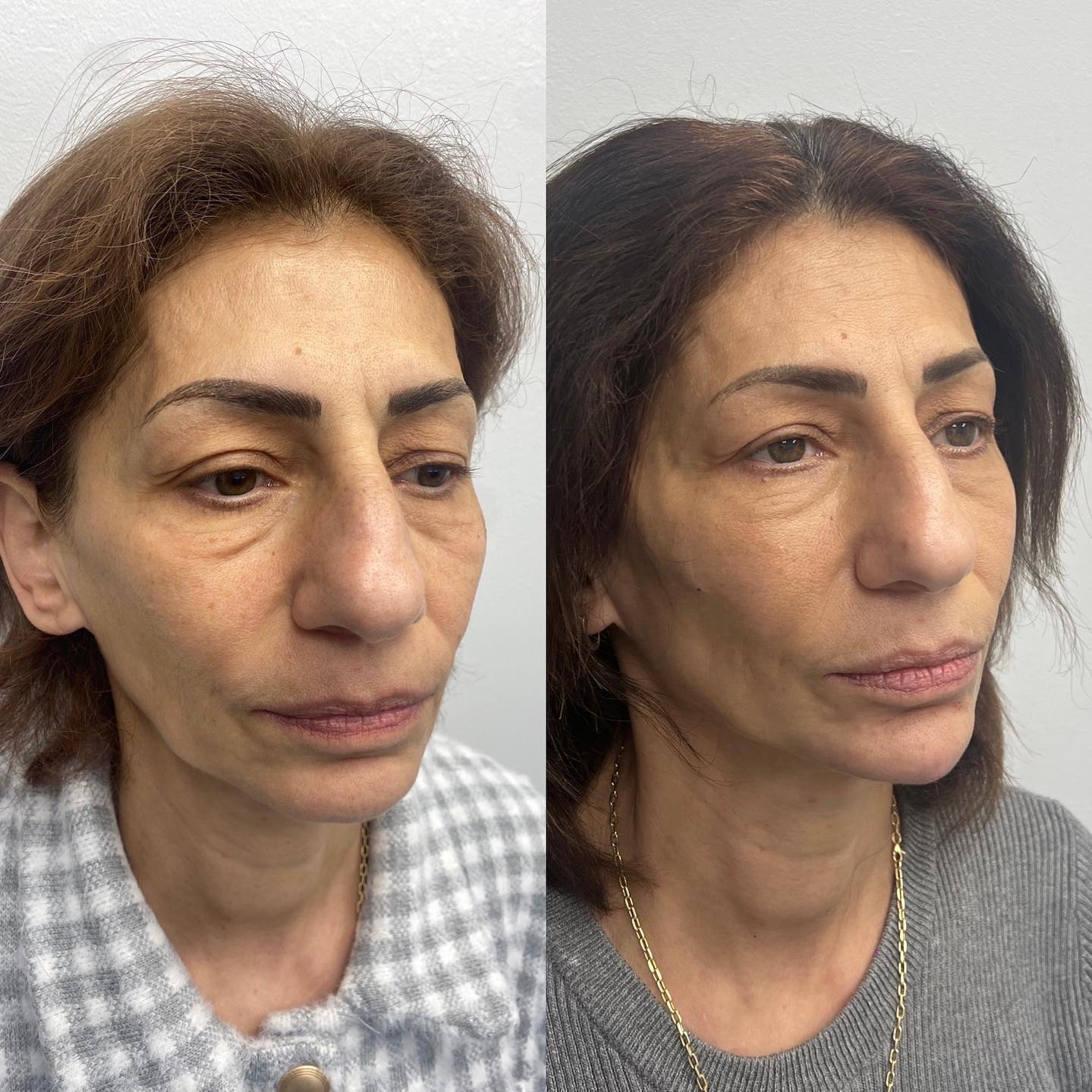 Client had multiple syringes injected in her cheeks + chin to achieve a more youthful appearance and facial balance. Next cli