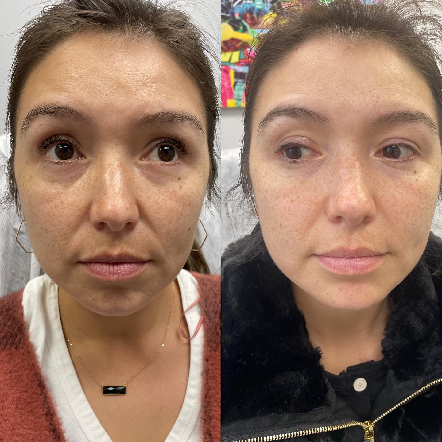 Client has only done 1 session of Morpheus8 full face + prime for eyes. Her smile lines + undereyes look a lot smoother alrea