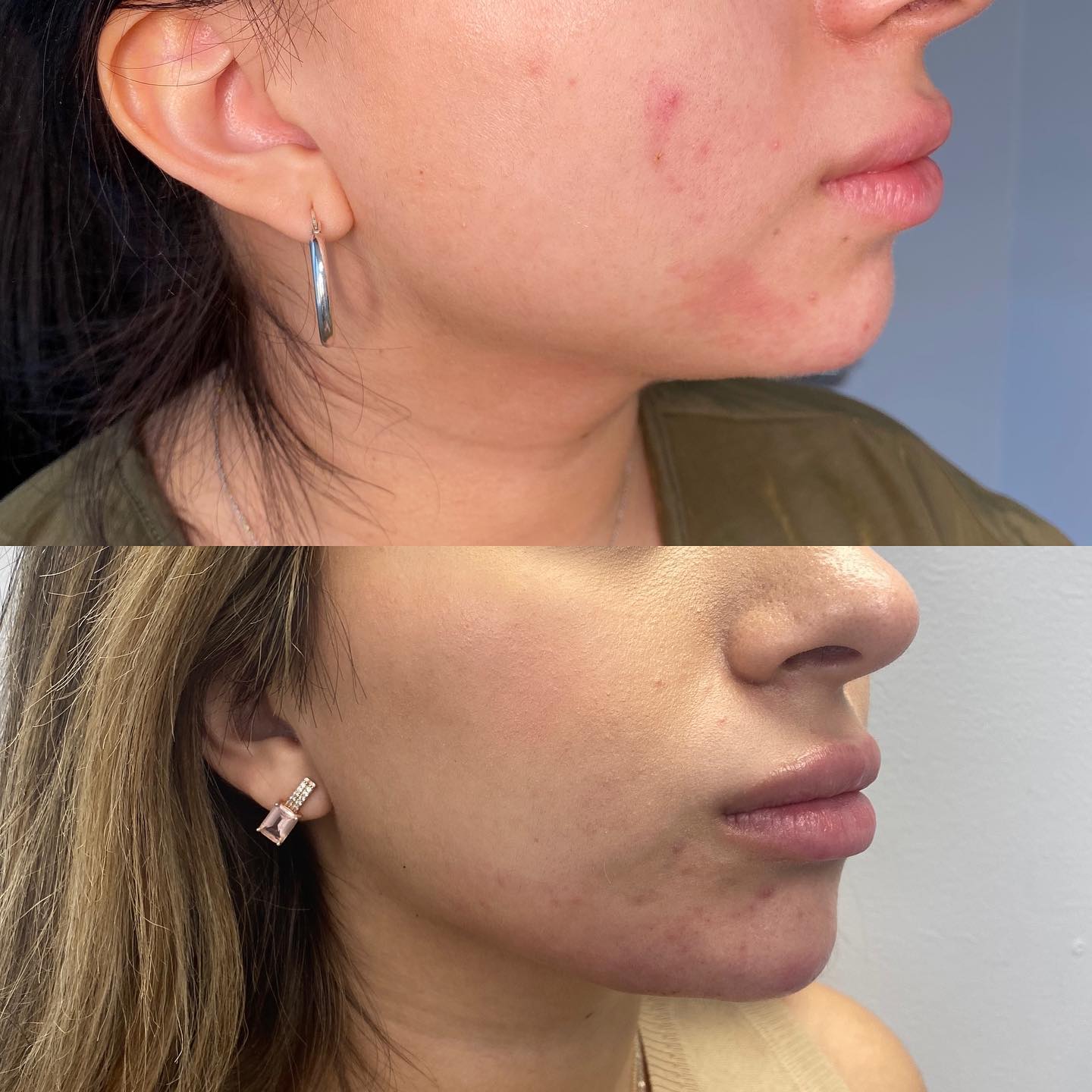 A soft-looking chin and jaw can be caused by age or genetics. Jaw fillers can add definition, symmetry, balance, or contour t