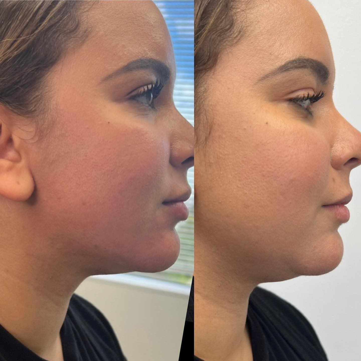 Thanks to its revolutionary skin tightening capabilities, many patients notice a firmer, more slender face shape after their