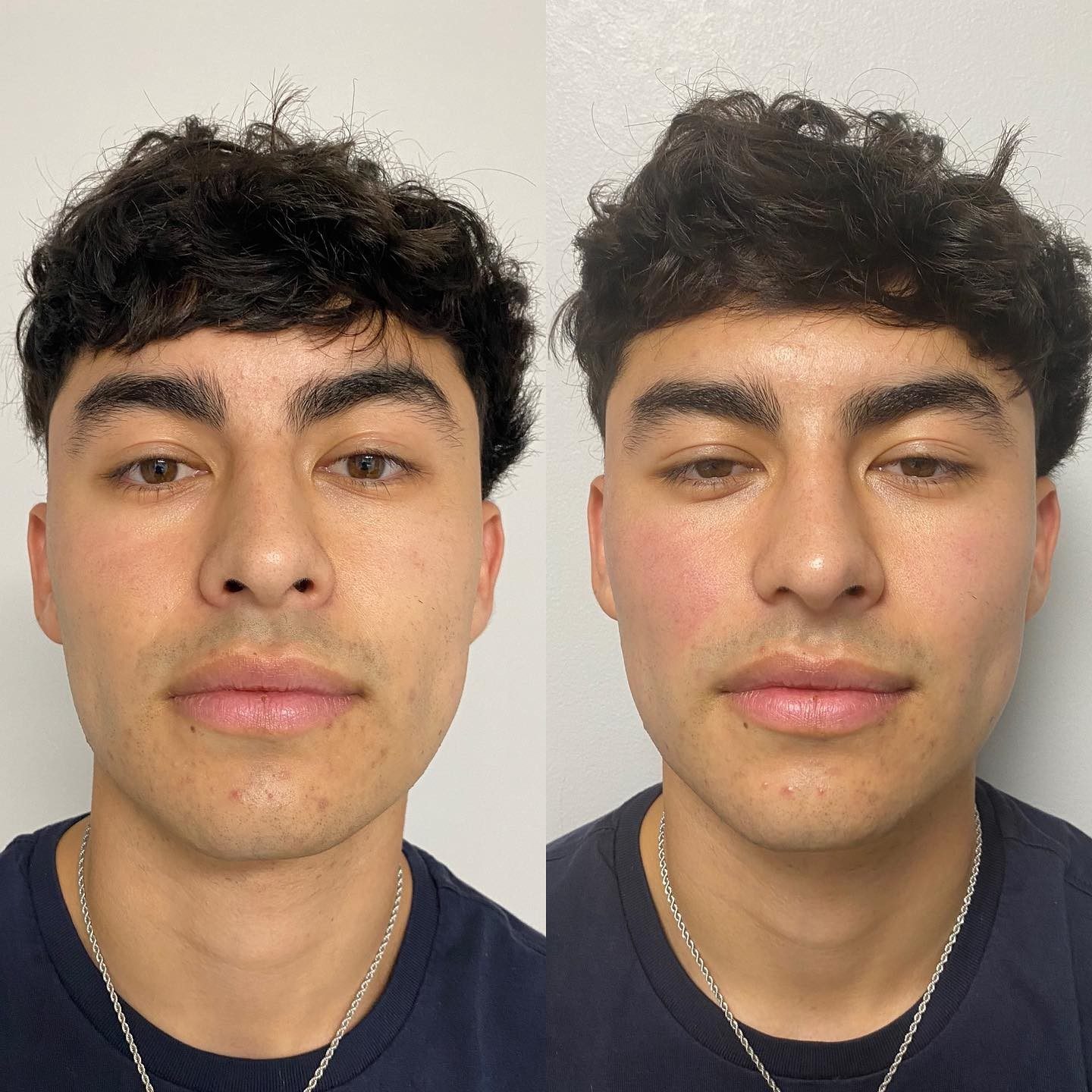 Looking full and tired? InMode Forma facial is a safe, effective way to tighten and plump your skin, without the use of needl