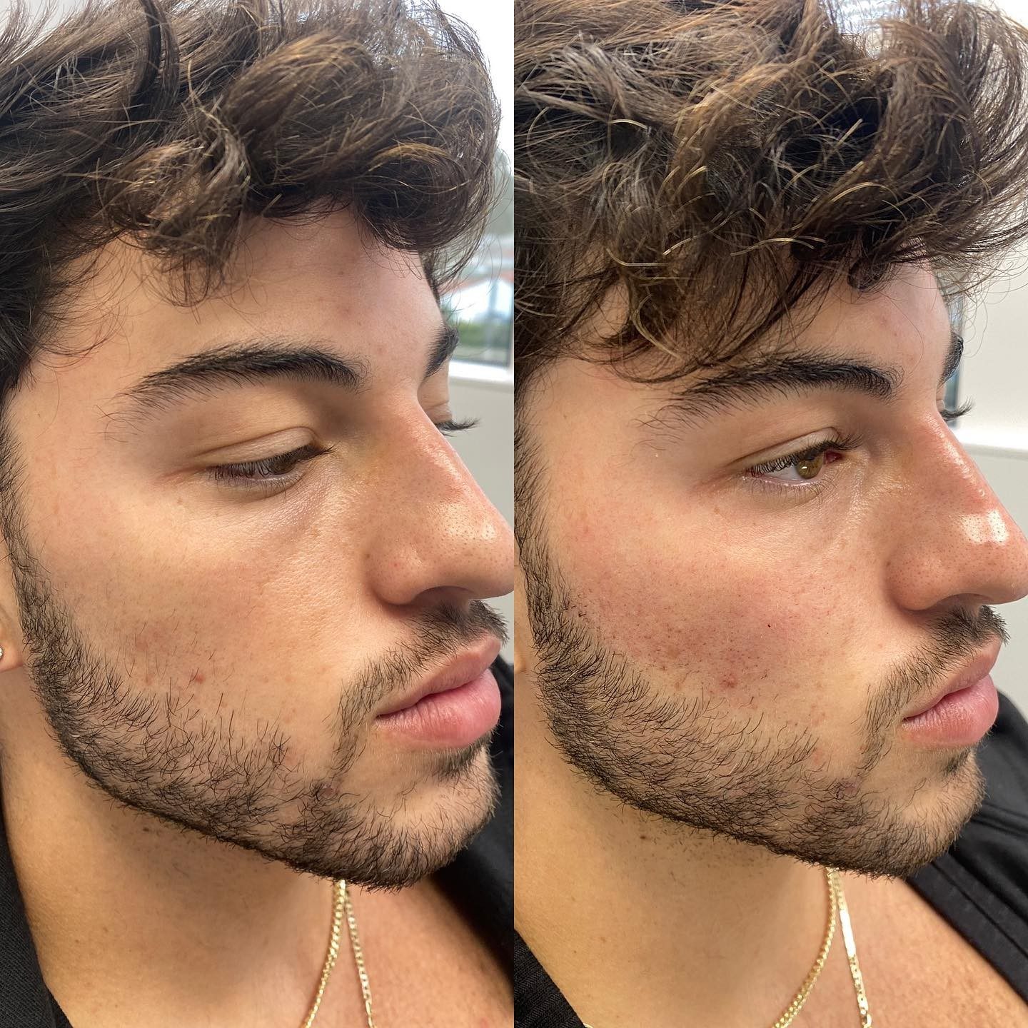 Lost volume in the cheeks is a surefire sign of aging. Deep within your cheeks is a special area that houses fat. As the body
