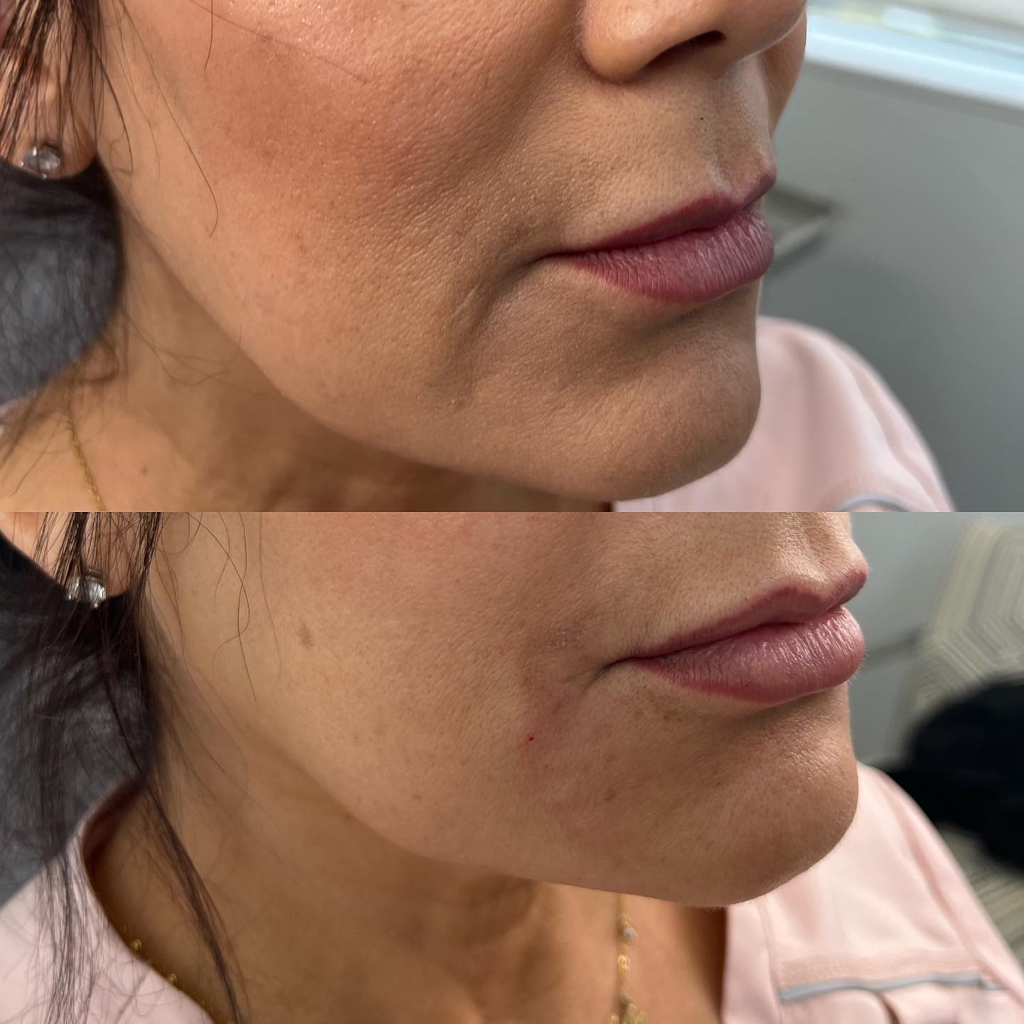😷Marionette lines are lines that originate at the corners of the mouth and can continue down to the chin and jaw line. These