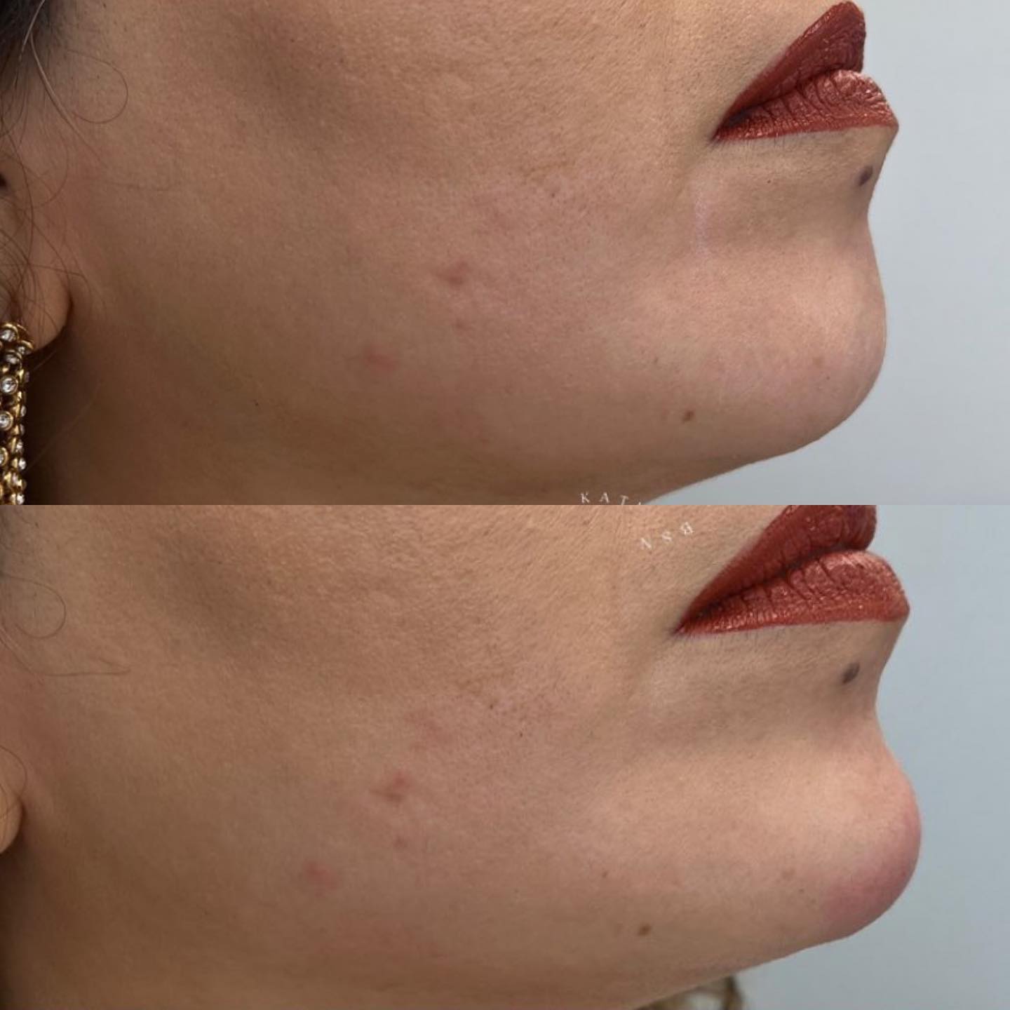 A soft-looking chin can be caused by age or genetics. Chin fillers can add definition, symmetry, balance, or femininity. Fill