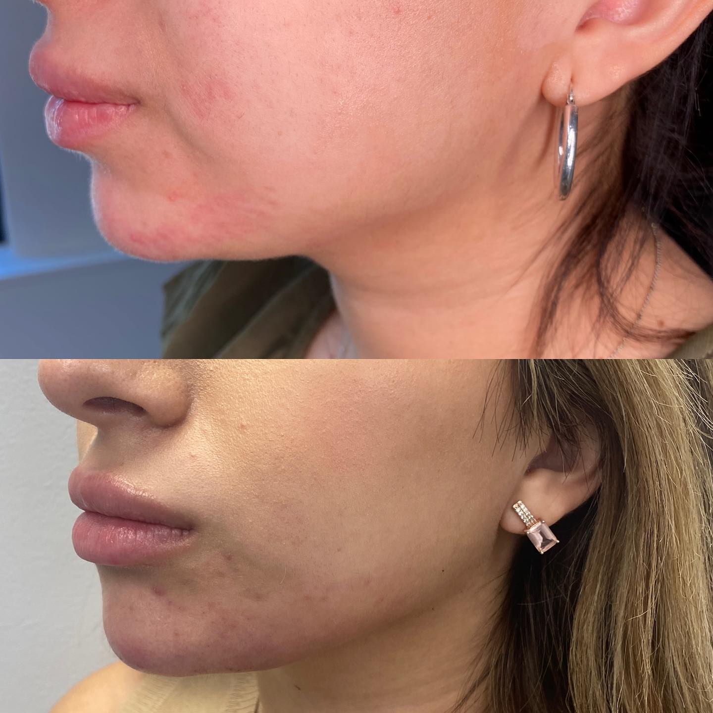 Profile Balancing is where a back-set chin is reharmonised in the correct ratio to the nose and lips, therefore, balancing ou