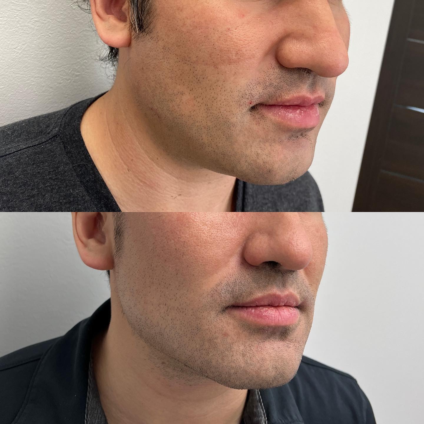There’s a reason why Morpheus8 has become one of the most effective anti aging tools in the market. In just 3 treatments, we