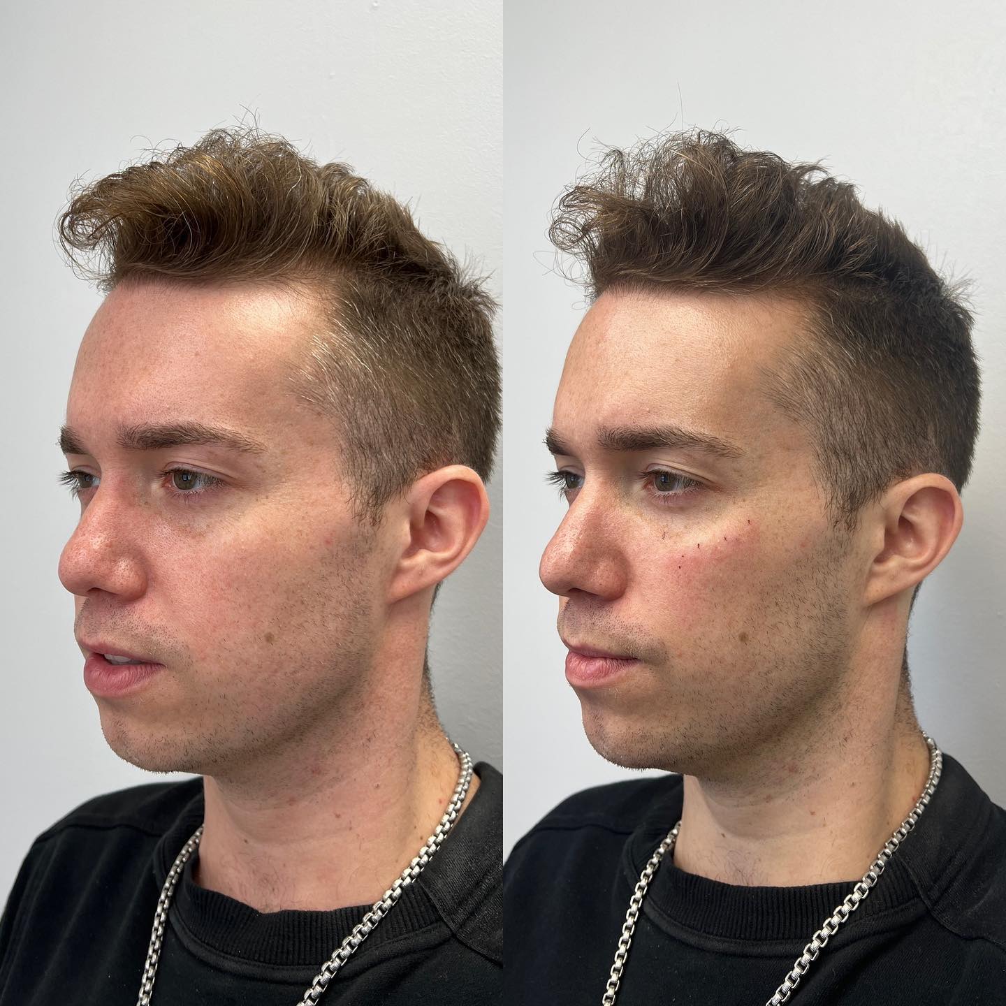 Chin + cheeks Client is looking more lifted and defined Using @restylaneusa @restylane to achieve this look #skinsationla #lo