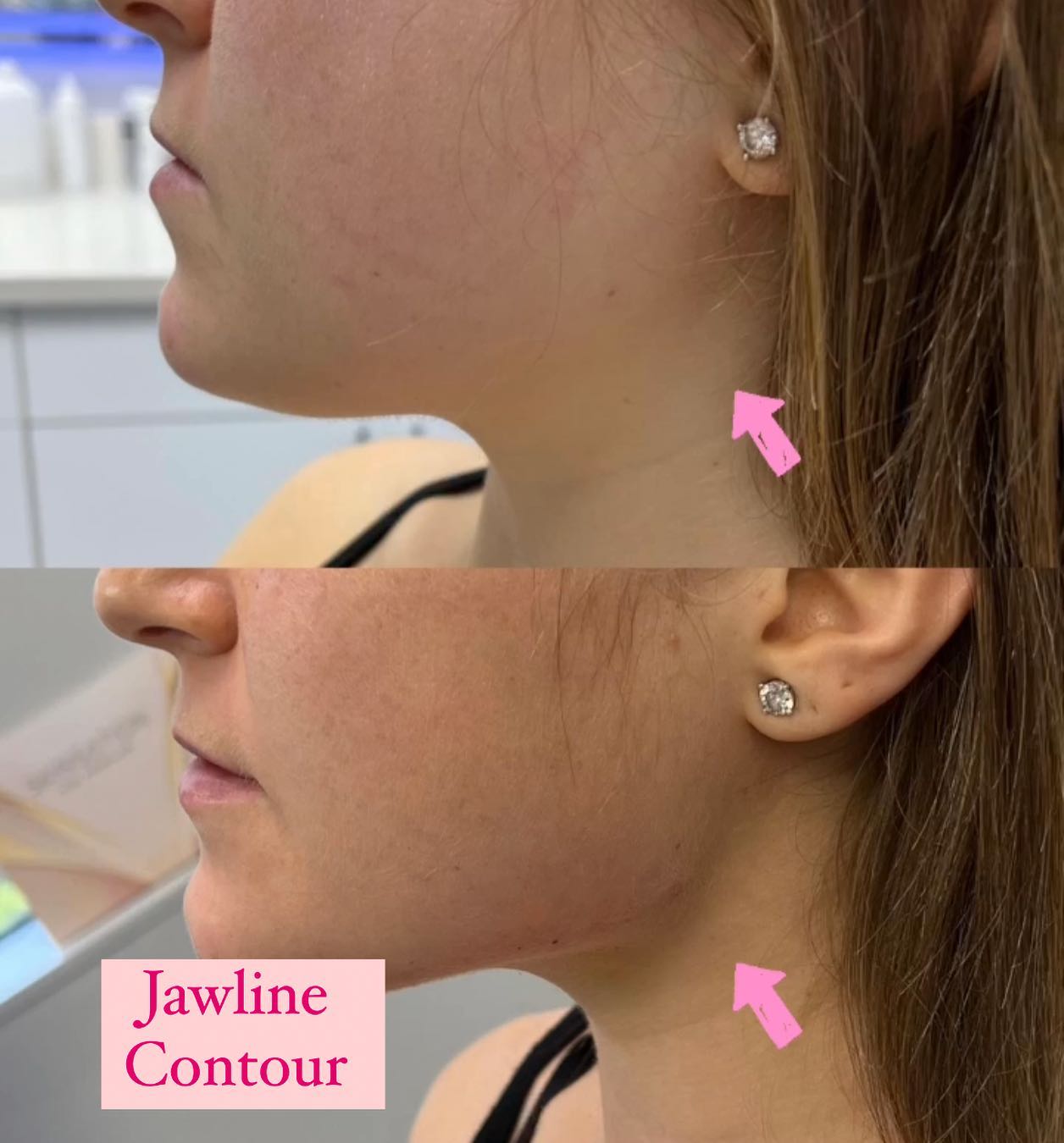 Our beautiful client wasn’t too happy about her jawline and wanted to get it more contoured and defined. We used 5 syringes o