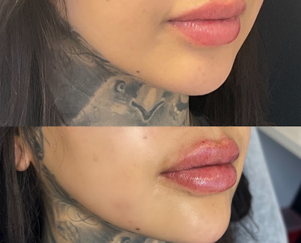 Lip enhancement