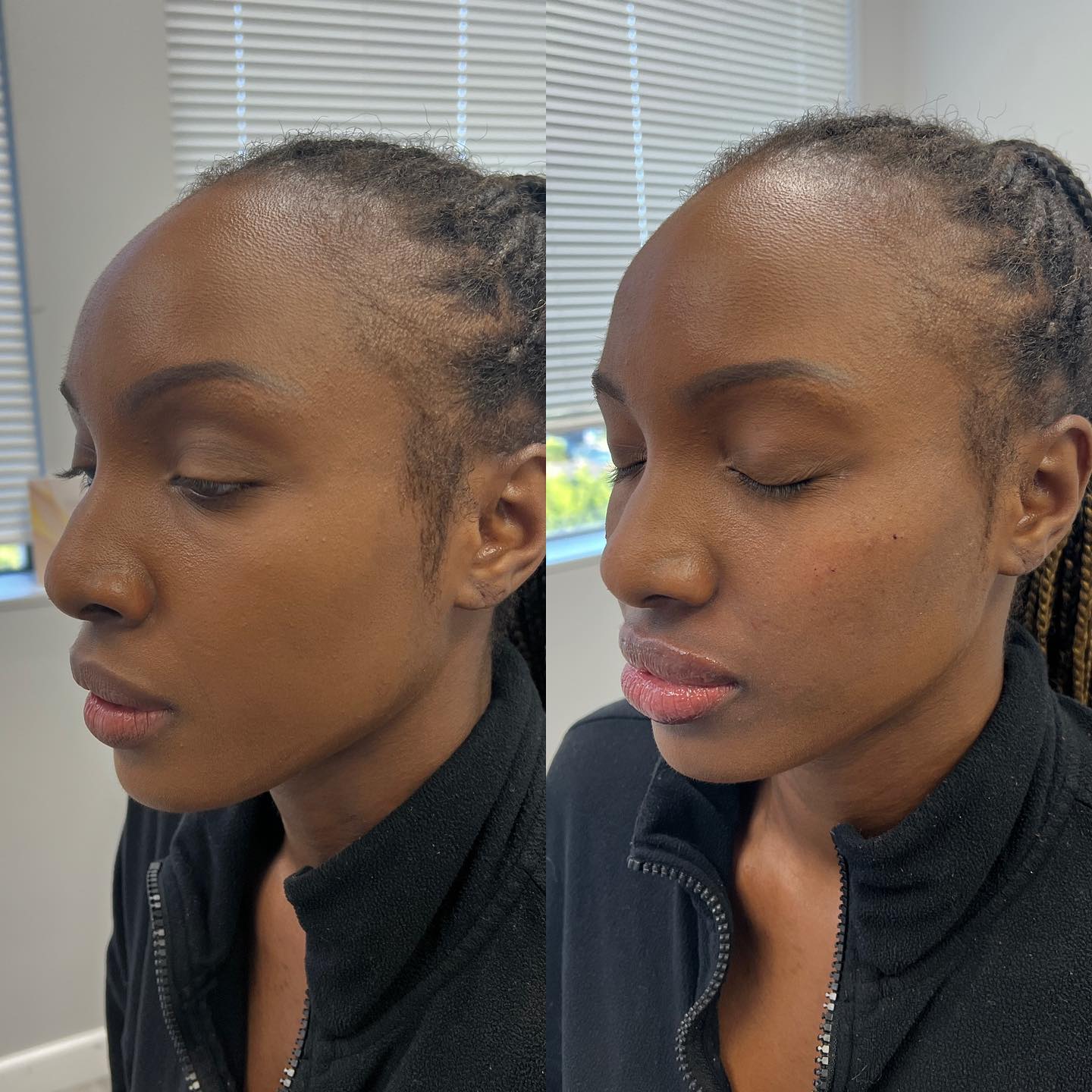 Cheeks + Lips for this beauty Cheek fillers are injections that raise the volume of the area above and around your cheekbones