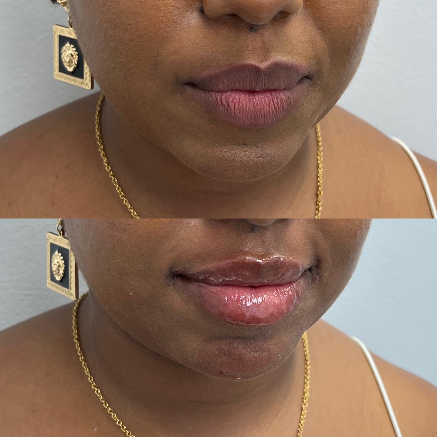 Lip Hydration with HA fillers 💉💦 . . While most people get lip fillers to add volume and shape, some clients get…
