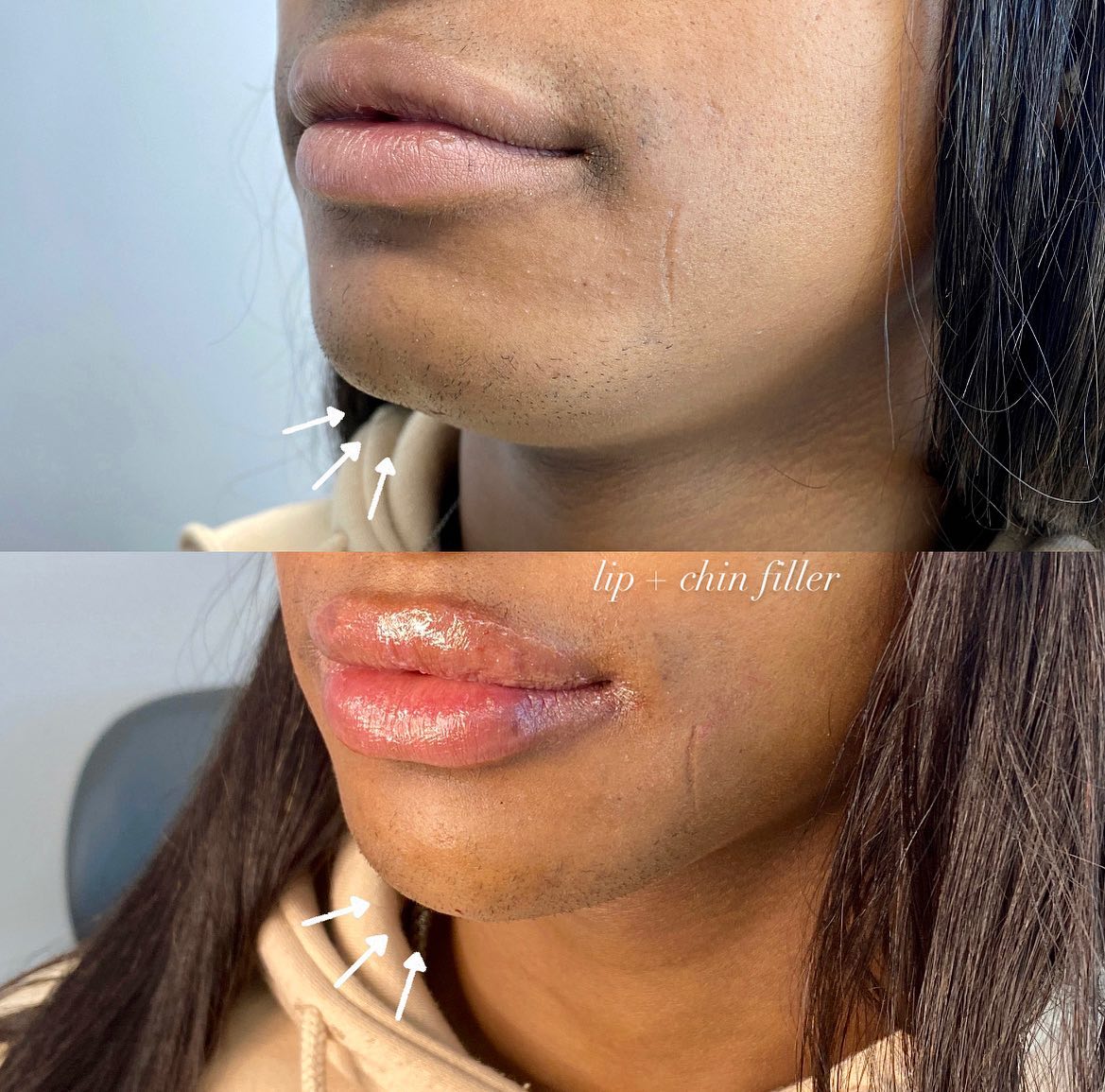 LIPS + CHIN FILLERS . . Alteration of jawline from square to v-shape using chin fillers. Chin fillers can make your face look