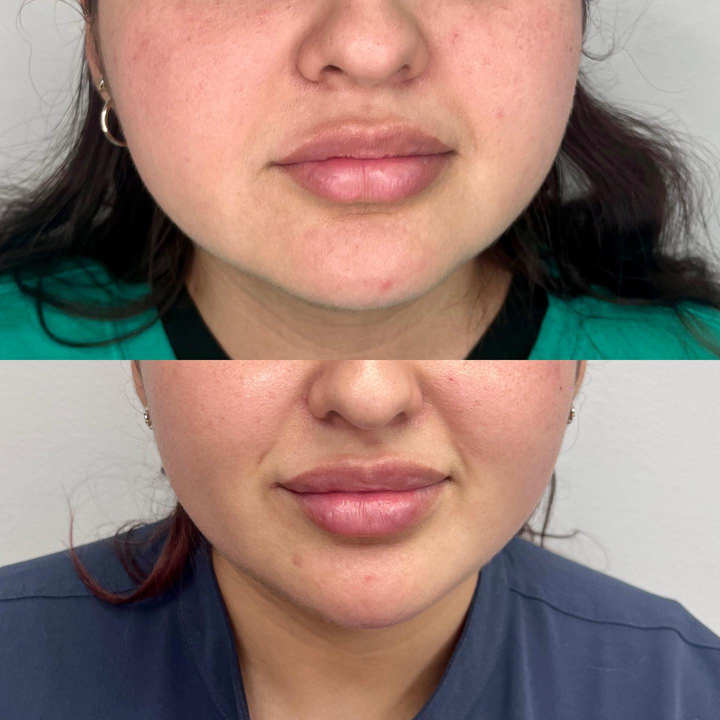 Results only after 1 session!! Morpheus8 by InMode combines radiofrequency (RF) technology and microneedling techniques to tr