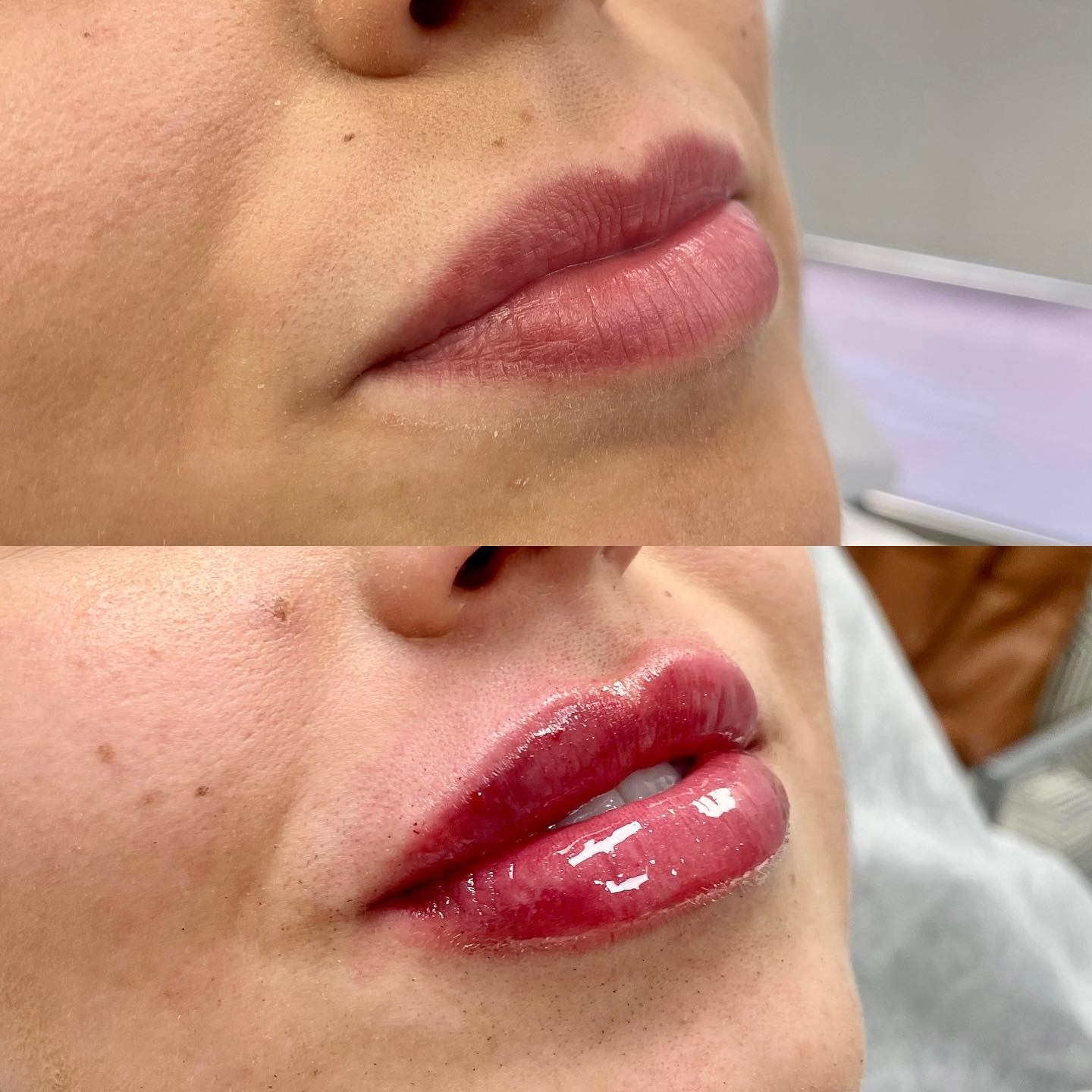 Starting Saturday with a full syringe of @revanesseusa . . #losangeles #medspa #beverlyhills #lipfiller #lip #lipflip #filler