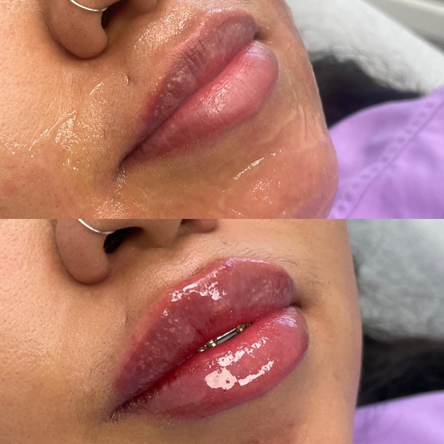 We used 1 full syringe of @revanesseusa to get nice pouty lips!
