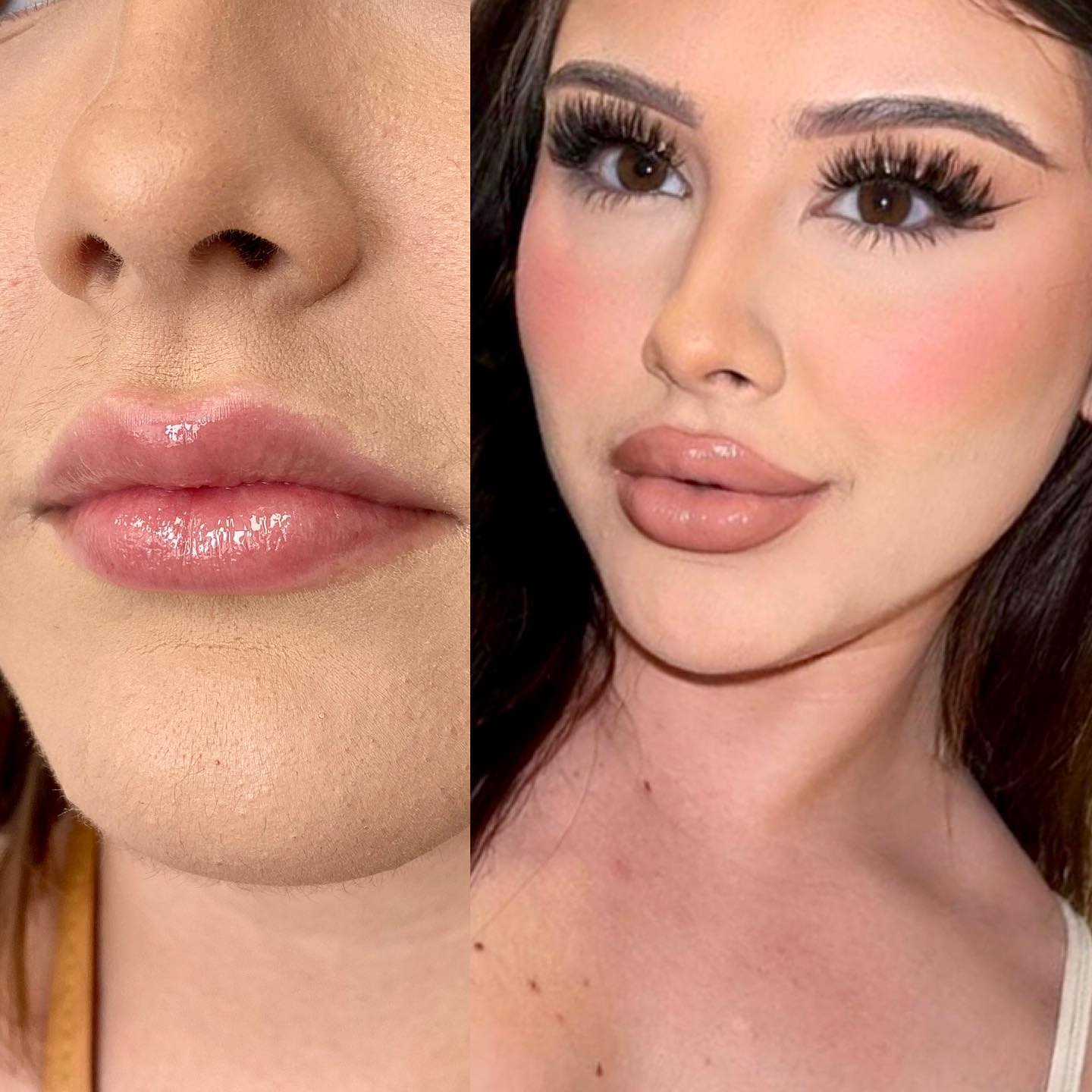 From that to this! Our beautiful girl had a great lip shape already, but she wanted more volume. We’ve been gradually buildin