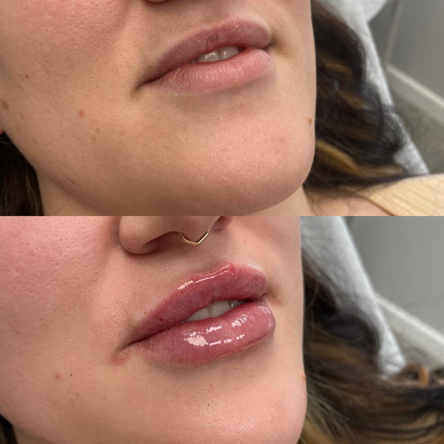 Half a syringe of filler for this beautiful Client! She wanted a very subtle and natural look and wanted to build her lips gr