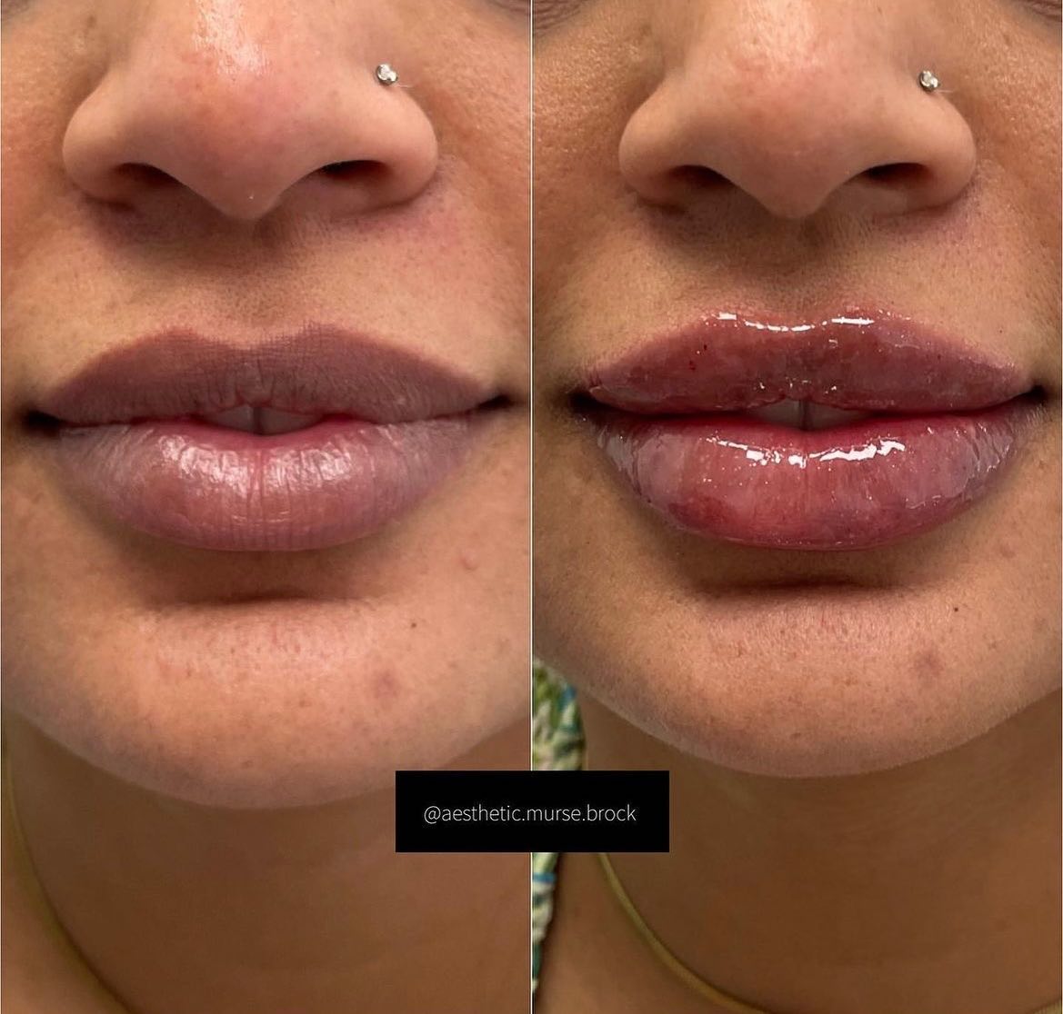 Lip Enhancement using restylane by @galderma.aesthetics Get $50 OFF on your next filler appointment! Limited space only