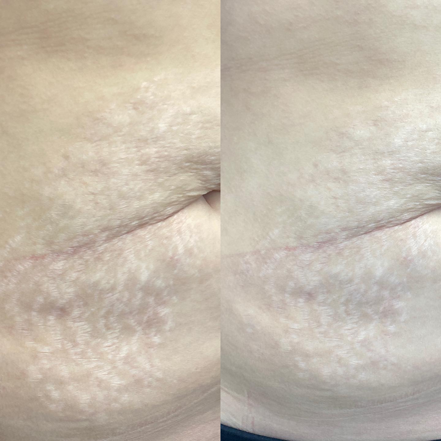 The picture on the right is a month post her 1st resurfacing treatment. Whether it’s stretch marks post pregnancy or weigh lo