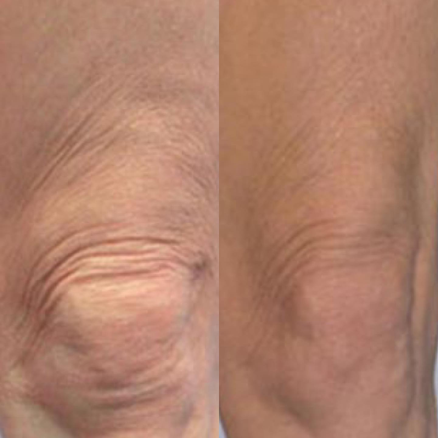 Morpheus8 can be used not only for the face but also for the body. It can be used to tighten loose skin on the inner and oute