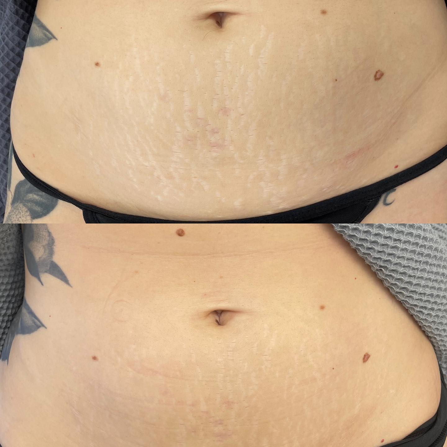 ✨1 session of stretch mark removal FAQ -How many sessions? Best results are seen after 3 sessions -How long does the session