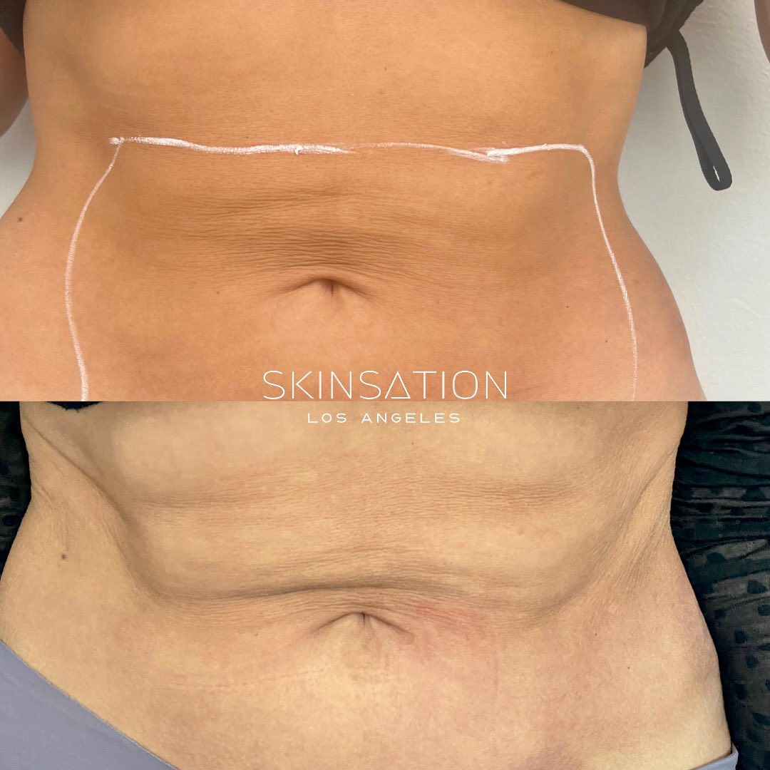 ✨SNATCHED ABS✨ You can now tighten not only your face, but also your body! This helps especially with the stubborn fat that g