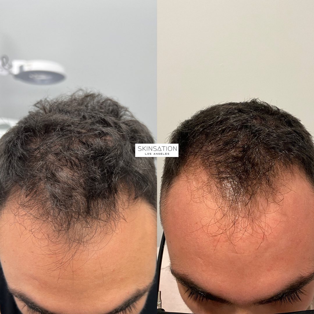 PRP & PRF Injections